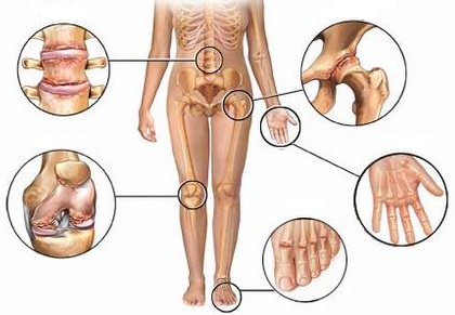 artrite anca ginocchio