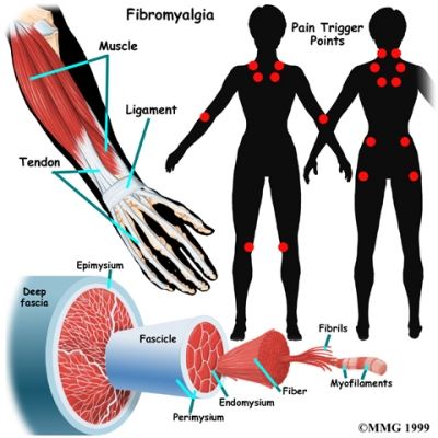 fibromialgia trigger points