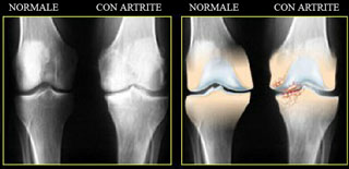 osteopatia artrite