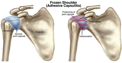 osteopatia frozen shoulder