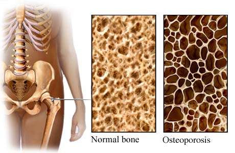 osteopatia osteoporosi