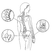 paradosso calcio osteoporosi