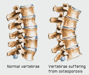 vertebre osteoporosi osteopatia