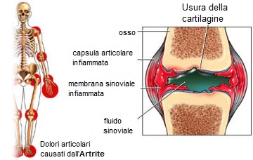 artrite cartilagine usura osteopatia