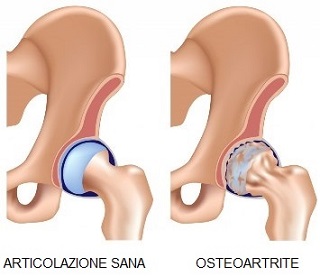 artrite osteoartrite anca