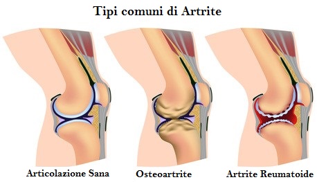 artrite osteopatia (2)