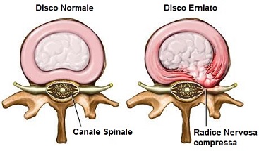 ernia del disco