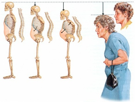 osteoporosi calcio