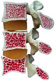 osteoporosi osteopatia