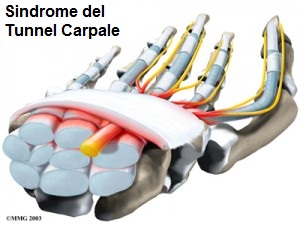sindrome tunnel carpale