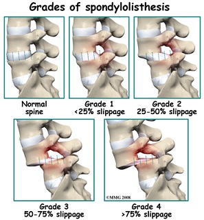 spondilolistesi lombare osteopatia